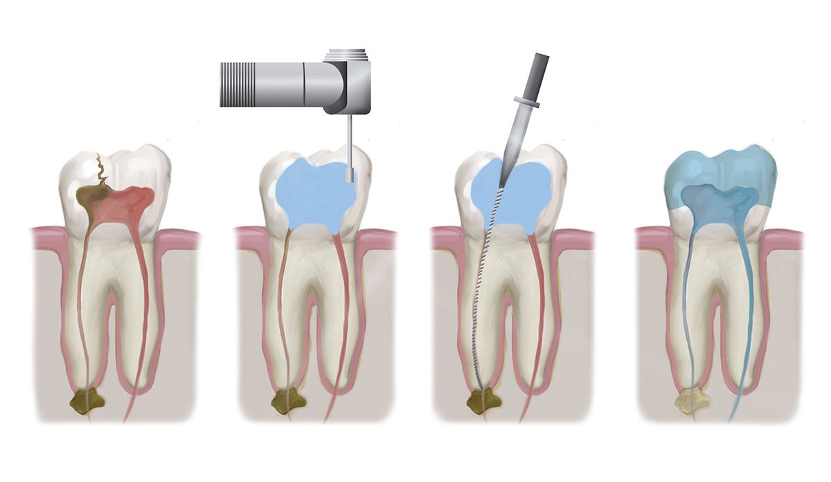 Illustration of stages of root canal therapy