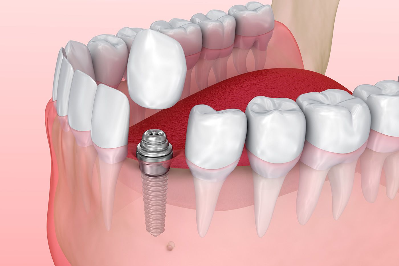 dental implant