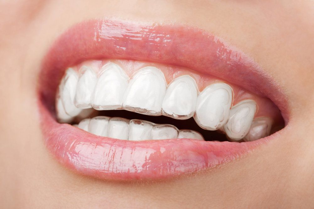 Close up of woman's teeth and Invisalign tray
