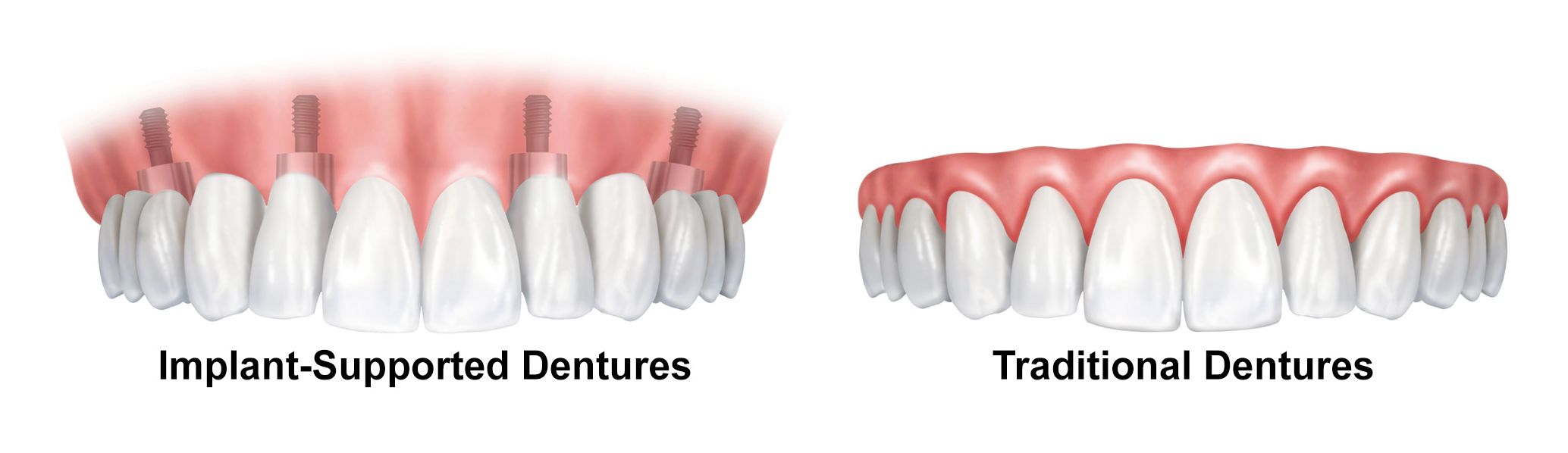 Illustration of traditional and implant-supported dentures