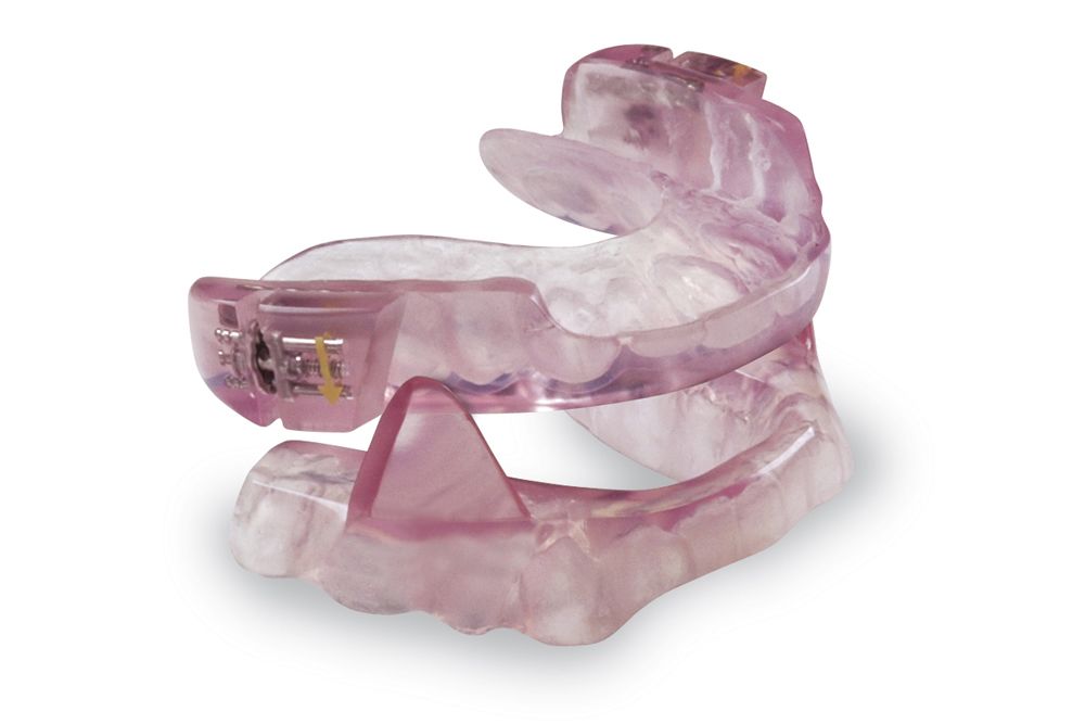 Photo of an oral sleep apnea appliance