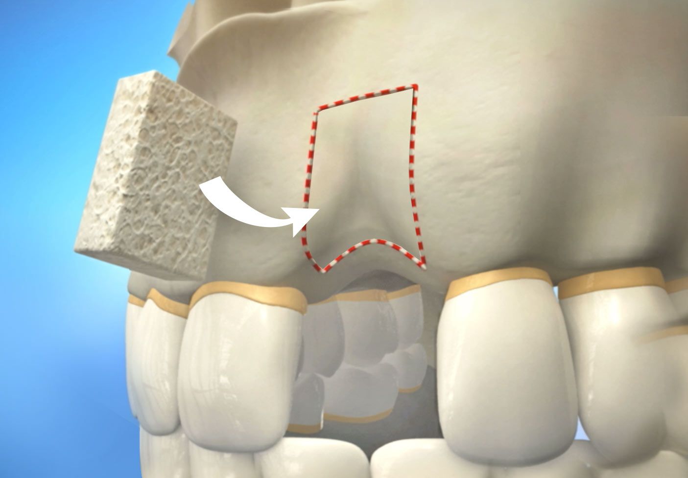 Illustration of dental bone grafting.