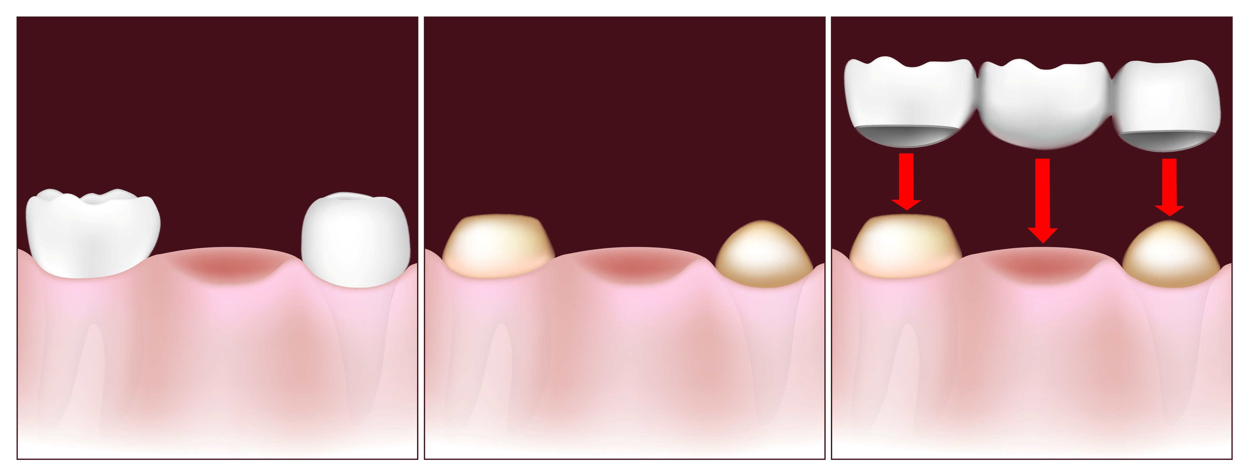 Graphic depicting traditional dental crown placement